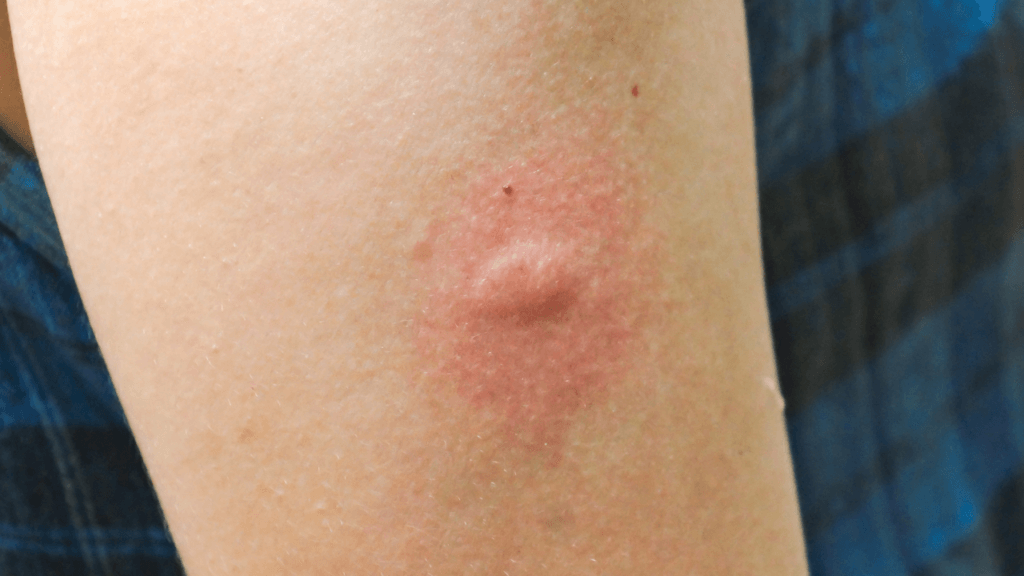 mosquito bite, itchy, bug spray, bug bite