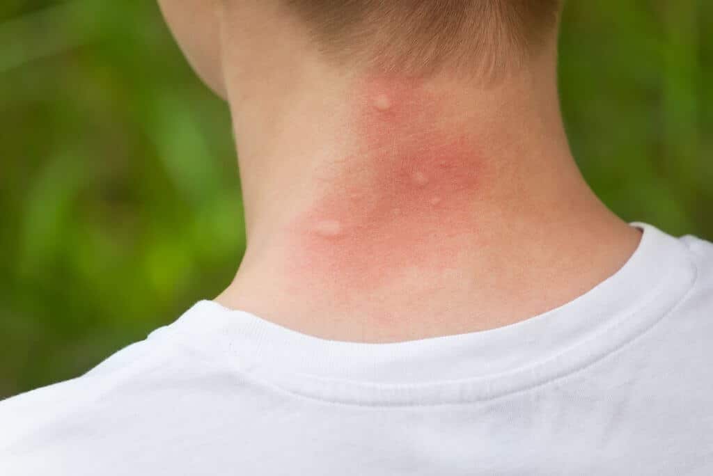 Mosquito bites on a persons neck, mosquito diseases, insect bites